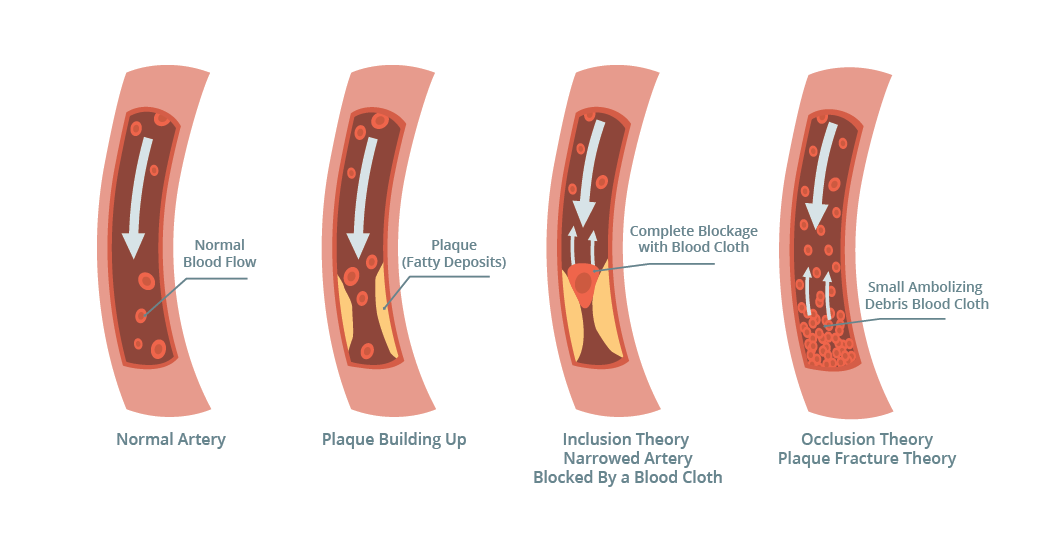Coronary Artery Disease