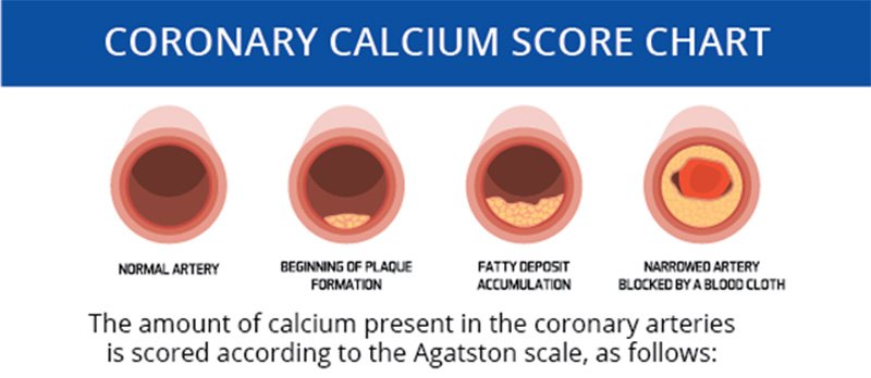 What Does A Calcium Score Test Show That Other Tests Do Not